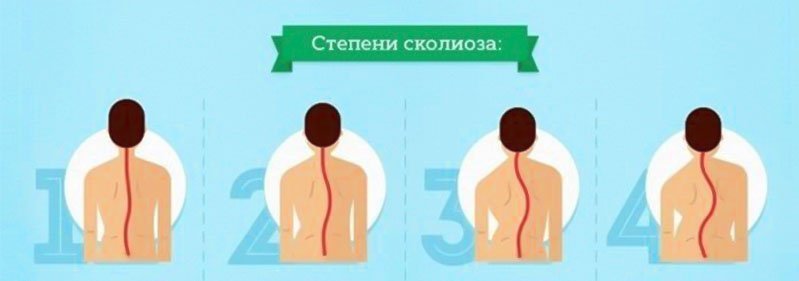 Степени сколиоза